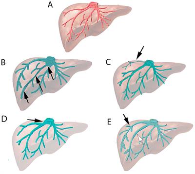 Induction of Robust Future Liver Remnant Hypertrophy Before Hepatectomy With a Modified Liver Venous Deprivation Technique Using a Trans-venous Access for Hepatic Vein Embolization